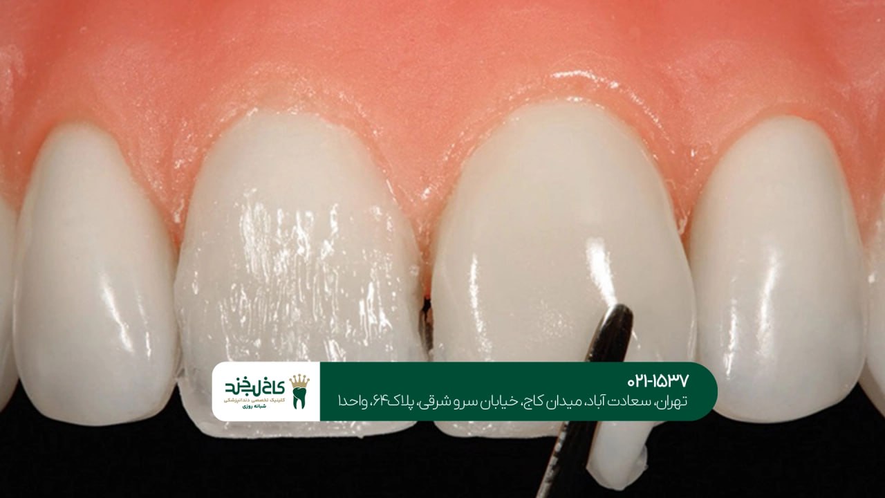 ترمیم دندان شکسته اقساطی ترمیم دندان شکسته اقساطی