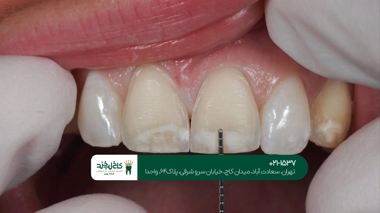 ترمیم دندان شکسته اقساطی ترمیم دندان شکسته اقساطی