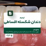 ترمیم دندان شکسته اقساطی