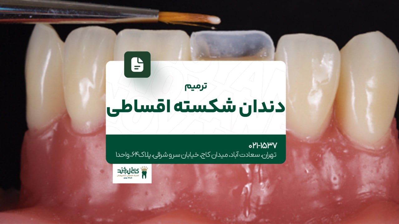 ترمیم دندان شکسته اقساطی ترمیم دندان شکسته اقساطی