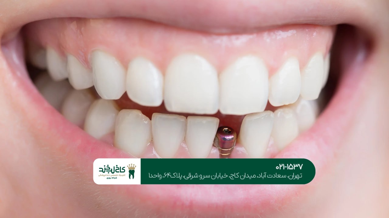 کاشت دندان در کلینیک شبانه روزی کاشت دندان در کلینیک شبانه روزی