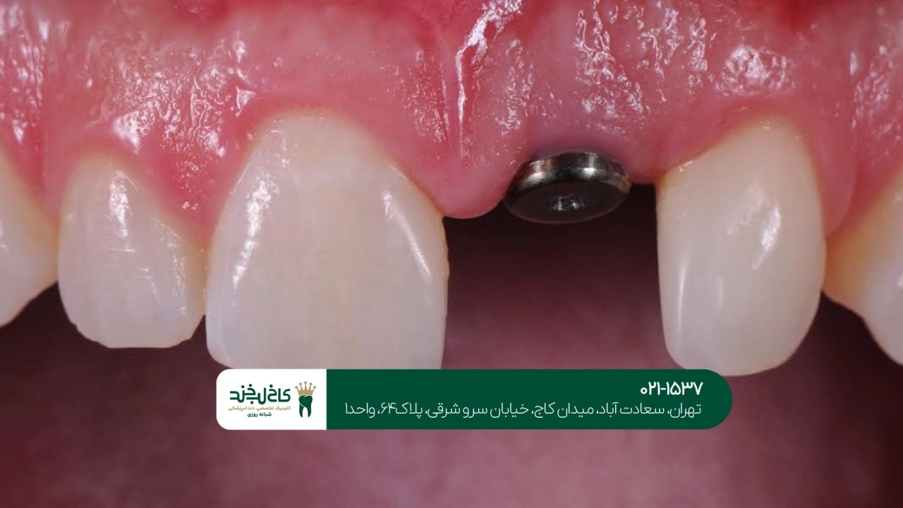 کاشت دندان در کلینیک شبانه روزی کاشت دندان در کلینیک شبانه روزی