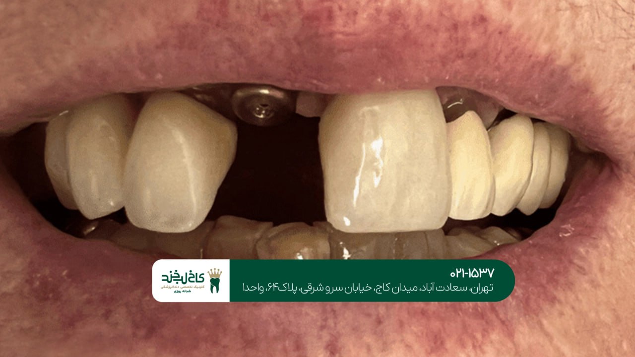 کاشت دندان در کلینیک شبانه روزی کاشت دندان در کلینیک شبانه روزی