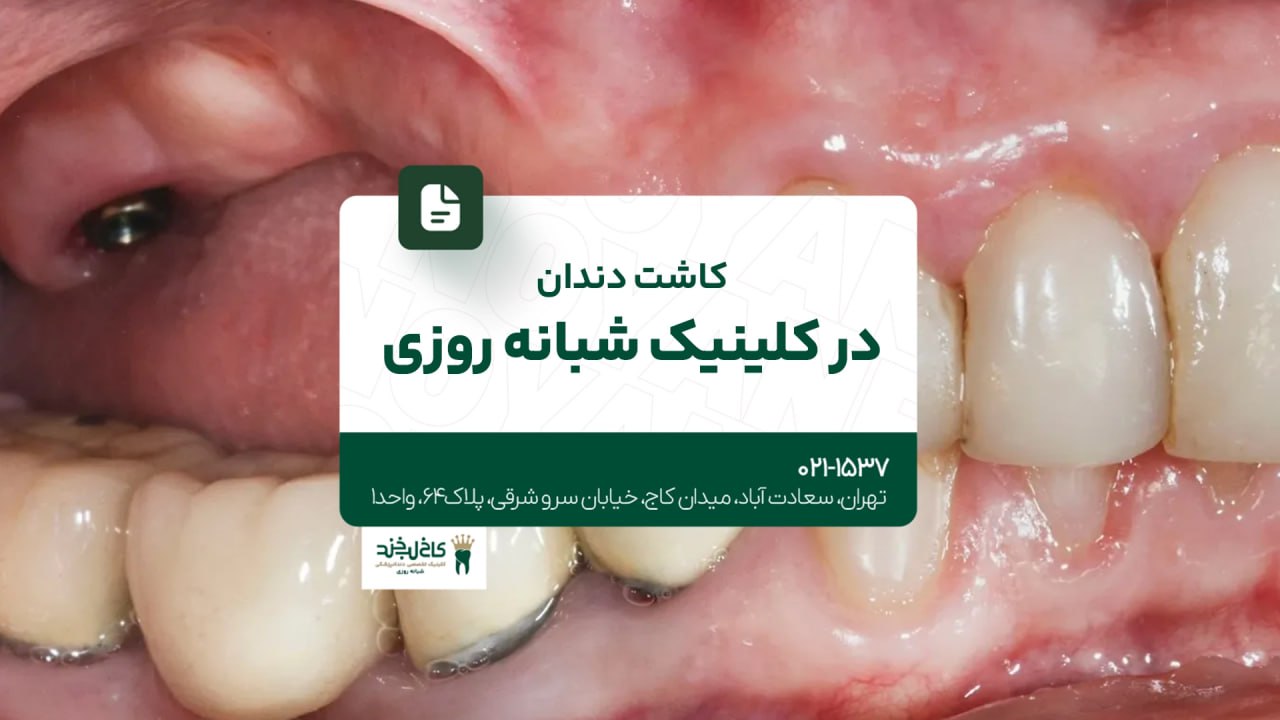 کاشت دندان در کلینیک شبانه روزی کاشت دندان در کلینیک شبانه روزی