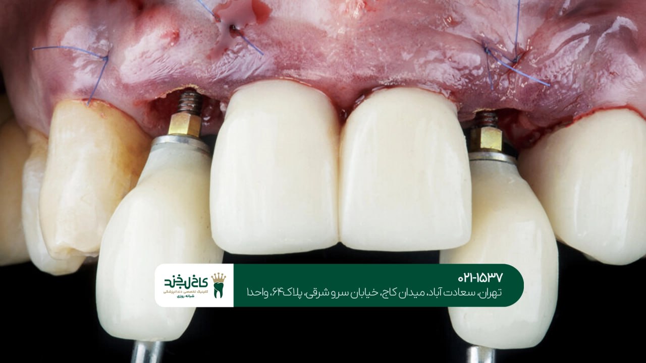 کلینیک تخصصی ایمپلنت شبانه روزی کلینیک تخصصی ایمپلنت شبانه روزی