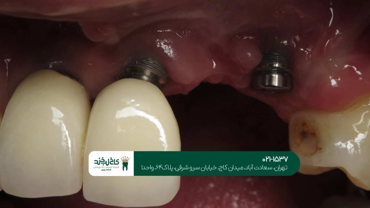 کلینیک تخصصی ایمپلنت شبانه روزی کلینیک تخصصی ایمپلنت شبانه روزی