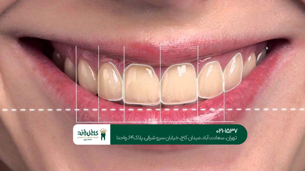 اصلاح طرح لبخند دیجیتال اقساطی