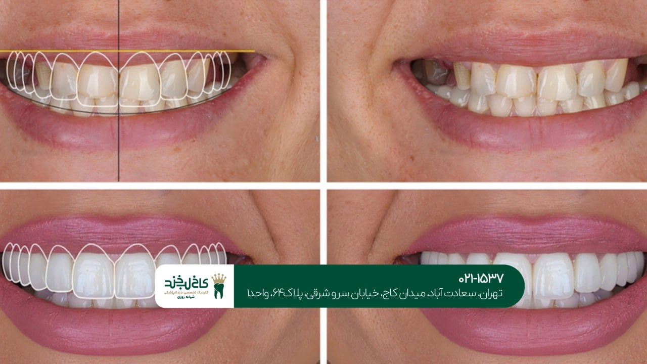 اصلاح طرح لبخند دیجیتال اقساطی