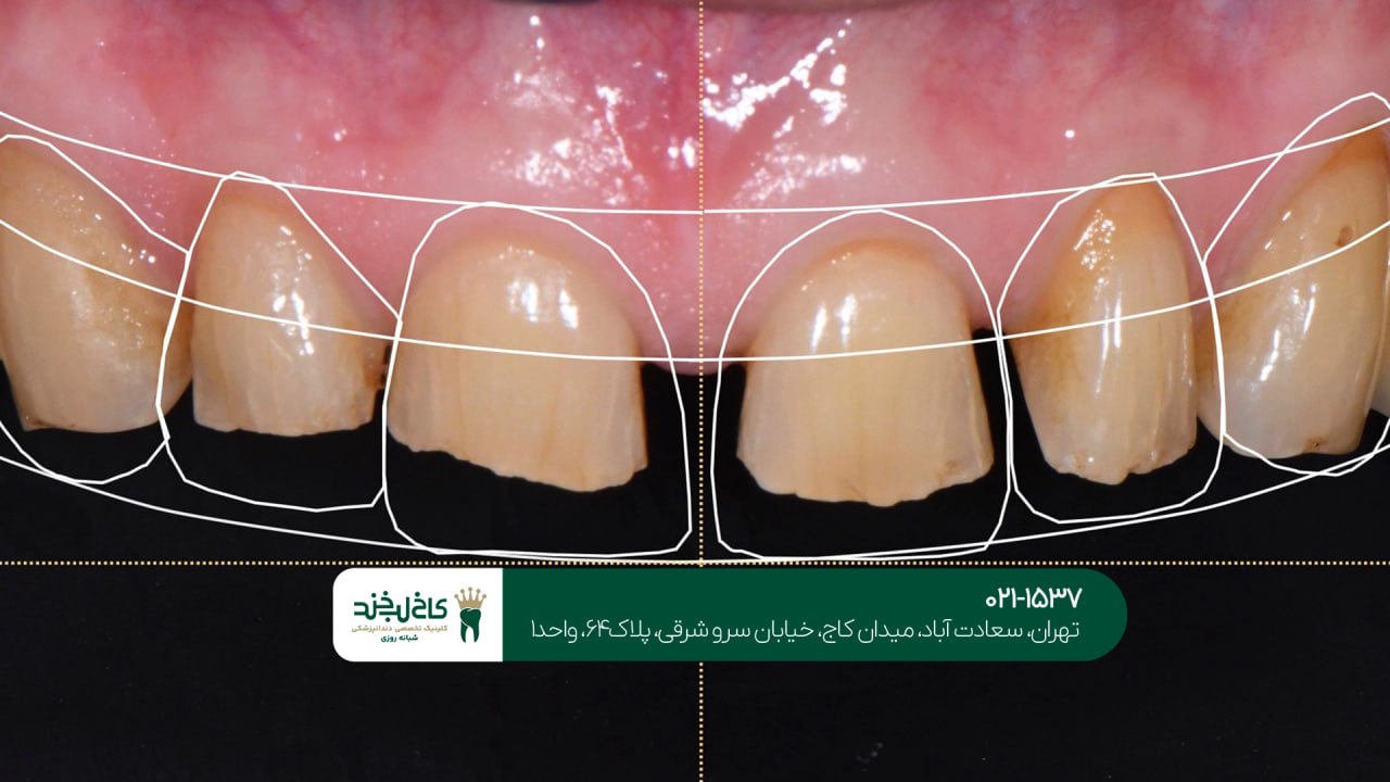 اصلاح طرح لبخند دیجیتال اقساطی