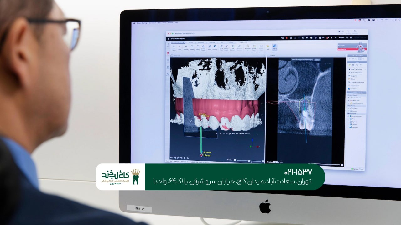 کاشت ایمپلنت دیجیتال در کلینیک تخصصی