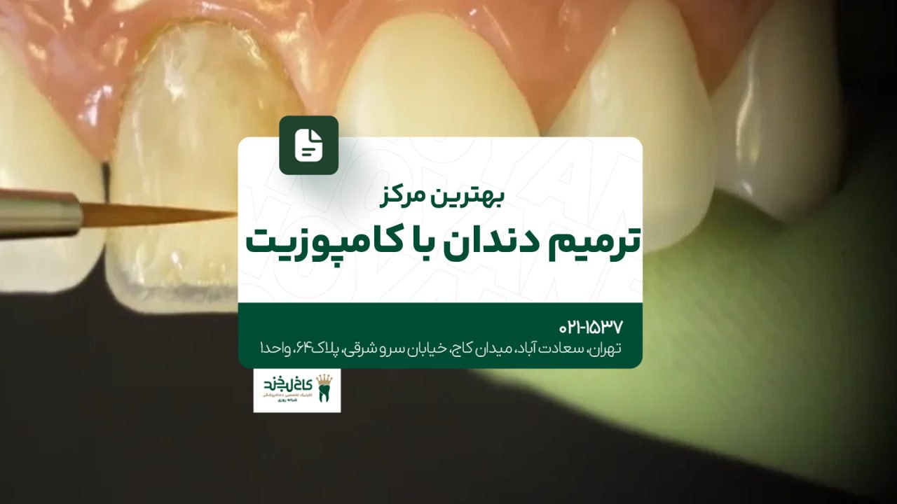 دندانپزشکی تخصصی لمینت سرامیکی دندانپزشکی تخصصی لمینت سرامیکی