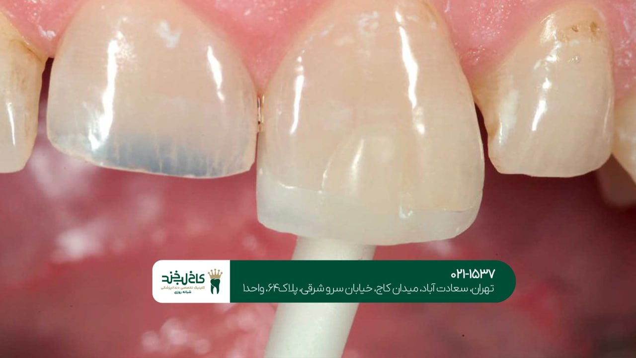 دندانپزشکی تخصصی لمینت سرامیکی دندانپزشکی تخصصی لمینت سرامیکی