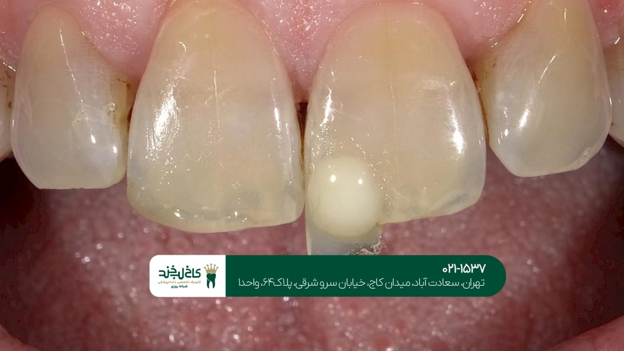 دندانپزشکی تخصصی لمینت سرامیکی دندانپزشکی تخصصی لمینت سرامیکی