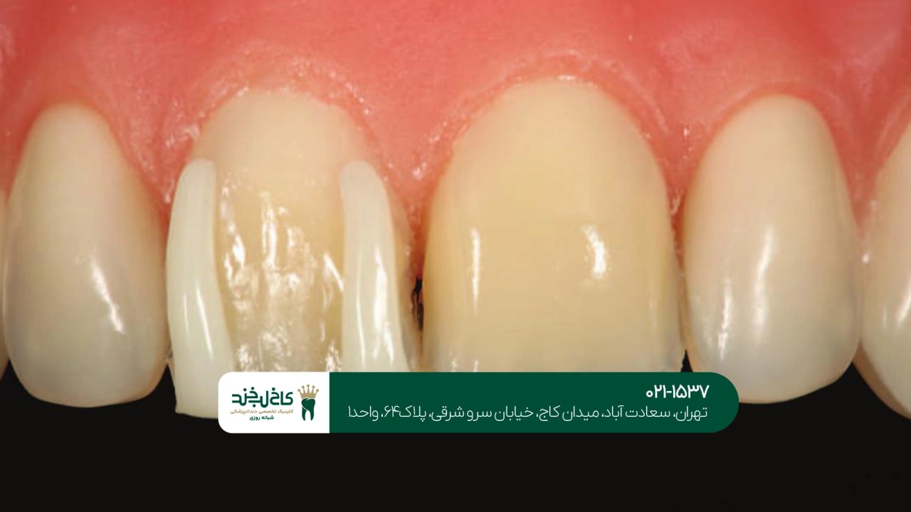 دندانپزشکی تخصصی لمینت سرامیکی دندانپزشکی تخصصی لمینت سرامیکی