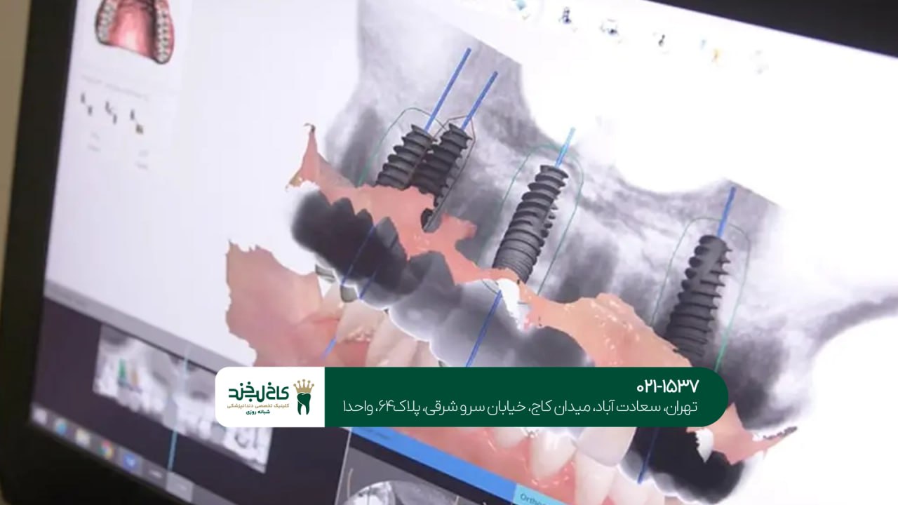 کاشت ایمپلنت با تکنولوژی مدرن کاشت ایمپلنت با تکنولوژی مدرن