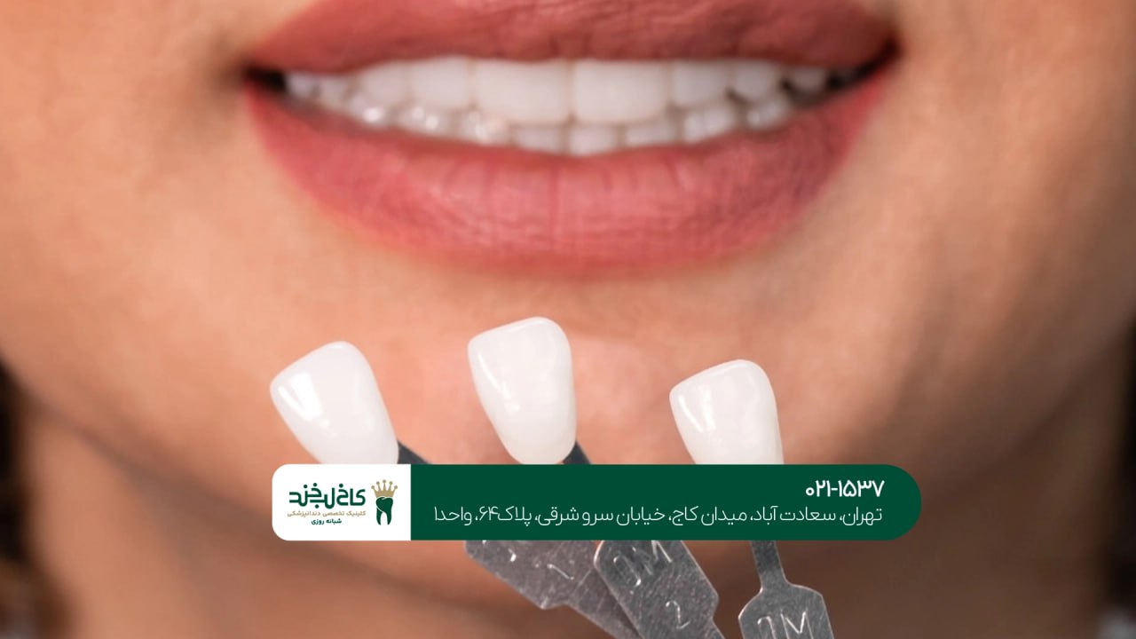 لمینت سرامیکی اقساطی لمینت سرامیکی اقساطی