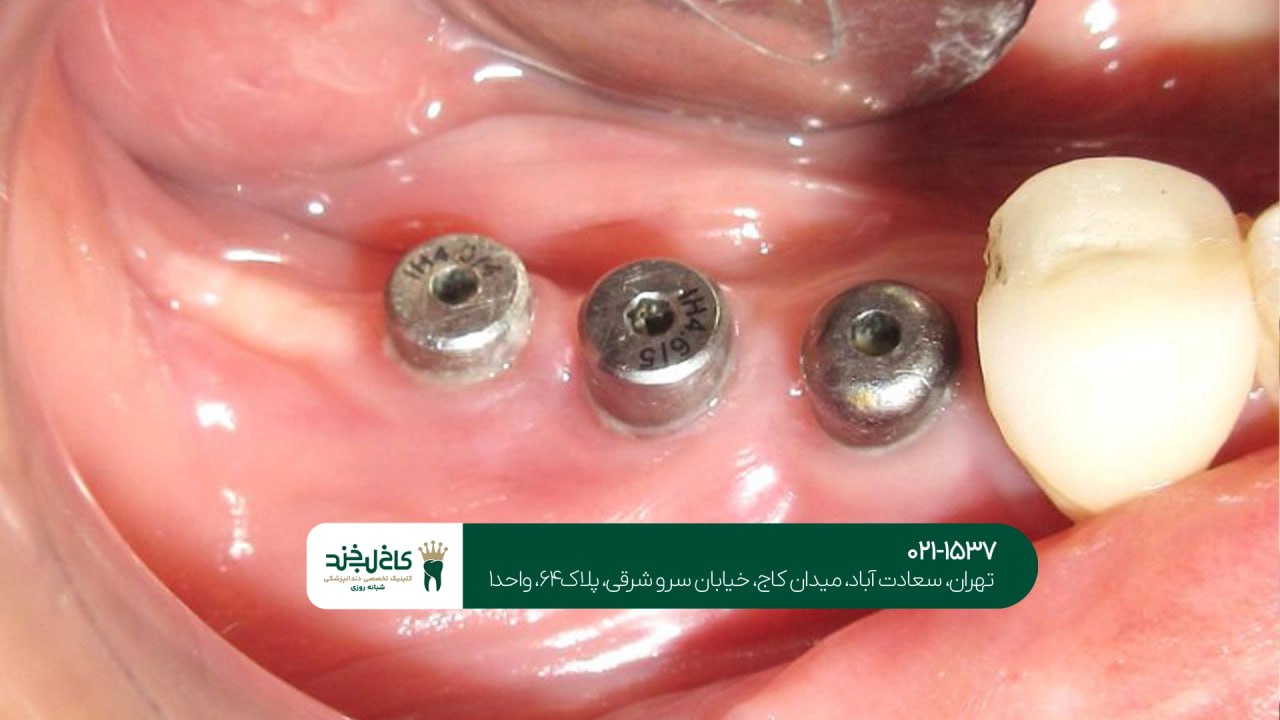 خدمات ایمپلنت یک روزه اقساطی خدمات ایمپلنت یک روزه اقساطی