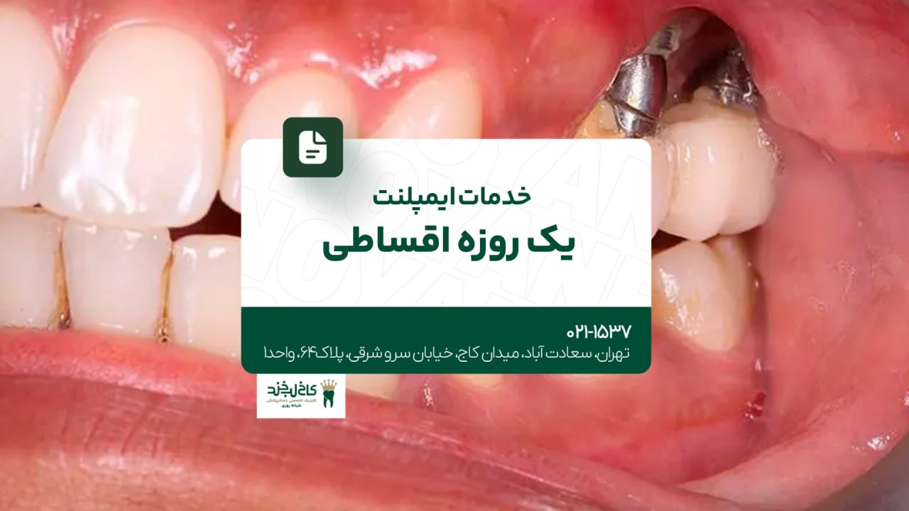 خدمات ایمپلنت یک روزه اقساطی خدمات ایمپلنت یک روزه اقساطی