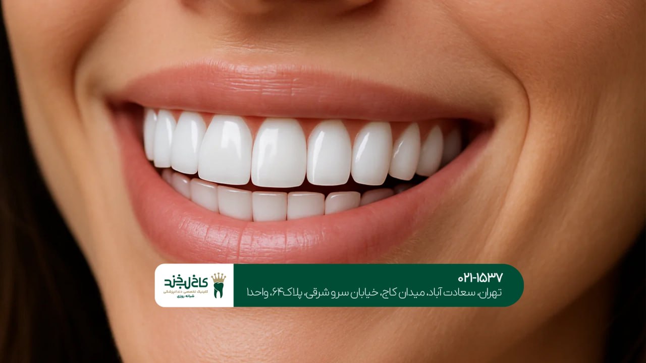 کامپوزیت ونیر اقساطی