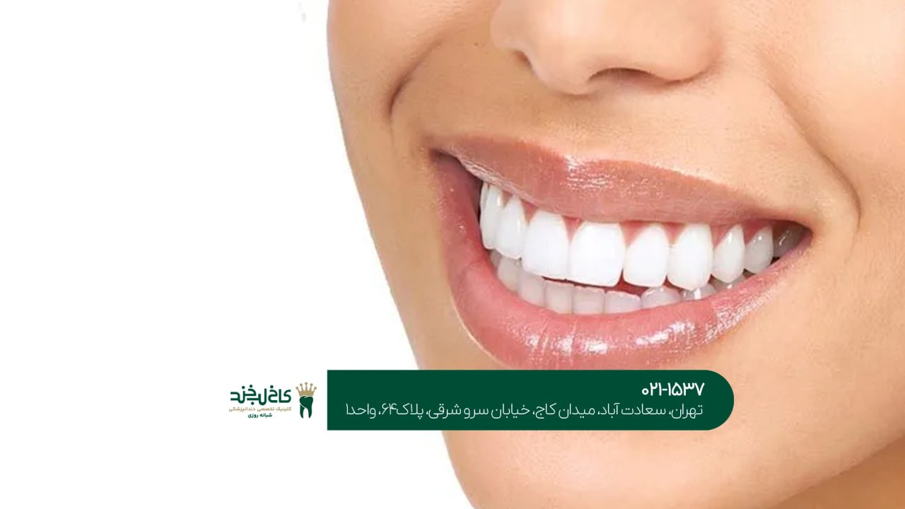 کامپوزیت ونیر اقساطی کامپوزیت ونیر اقساطی