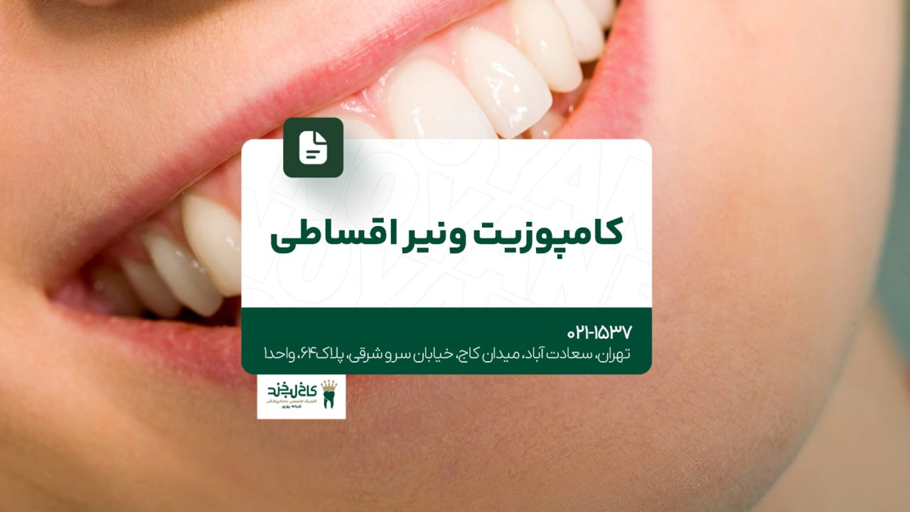 کامپوزیت ونیر اقساطی کامپوزیت ونیر اقساطی