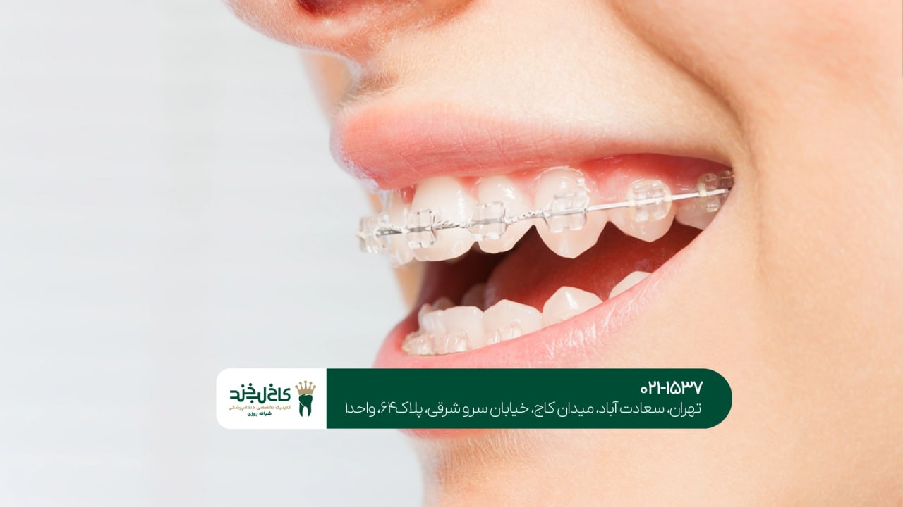 ارتودنسی نامرئی اقساطی ارتودنسی نامرئی اقساطی
