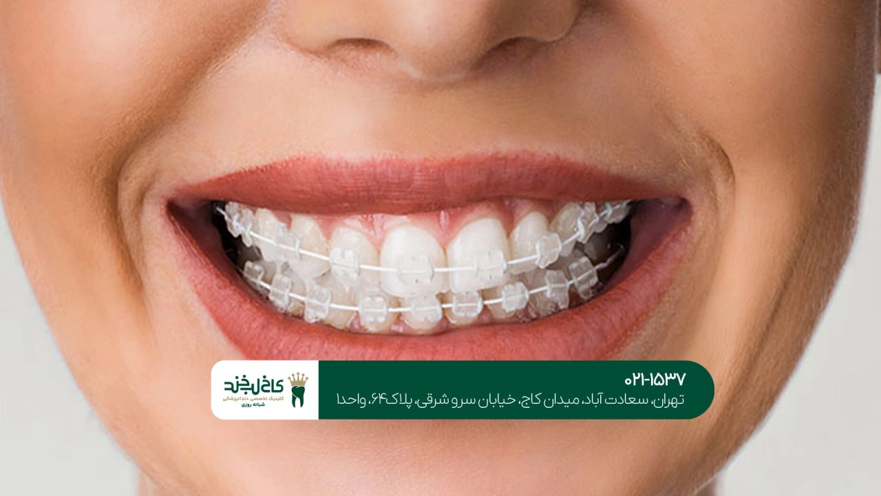 ارتودنسی نامرئی اقساطی ارتودنسی نامرئی اقساطی