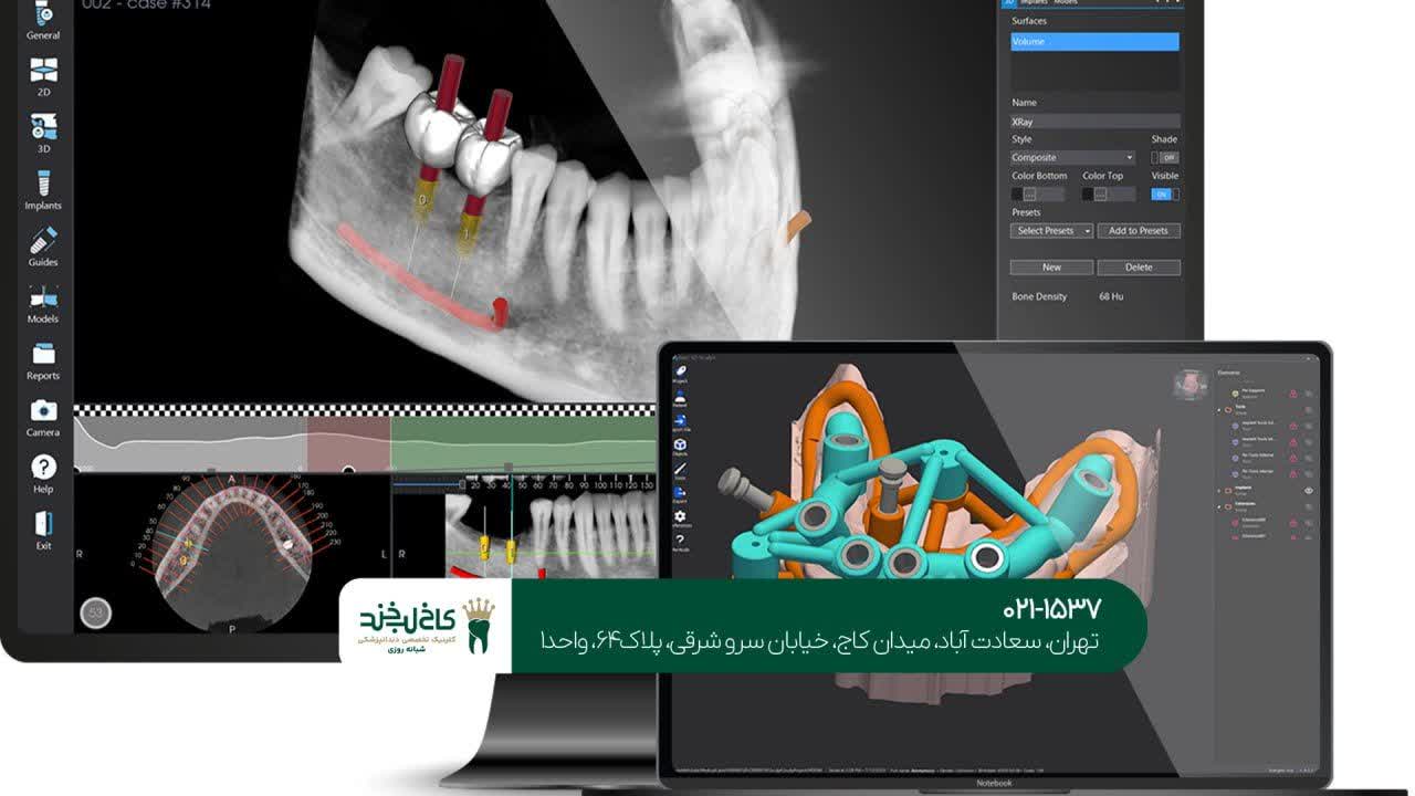 مرکز تخصصی ایمپلنت دیجیتال اقساطی مرکز تخصصی ایمپلنت دیجیتال اقساطی