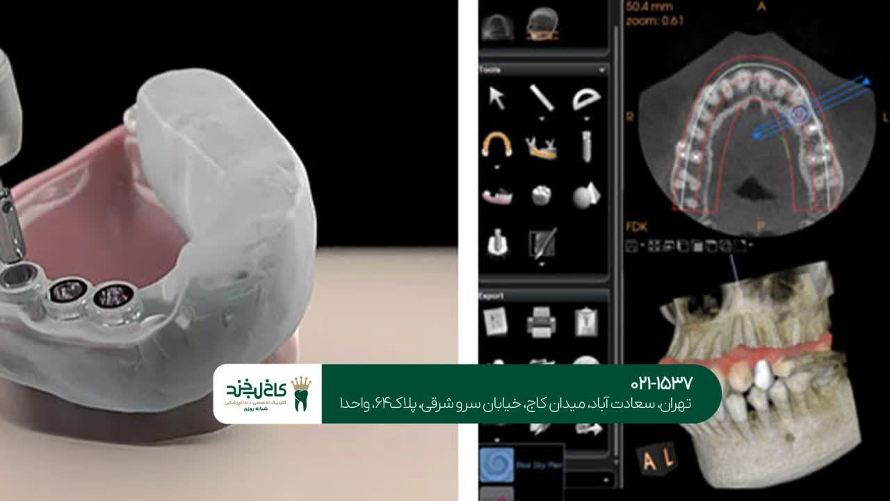 مرکز تخصصی ایمپلنت دیجیتال اقساطی مرکز تخصصی ایمپلنت دیجیتال اقساطی