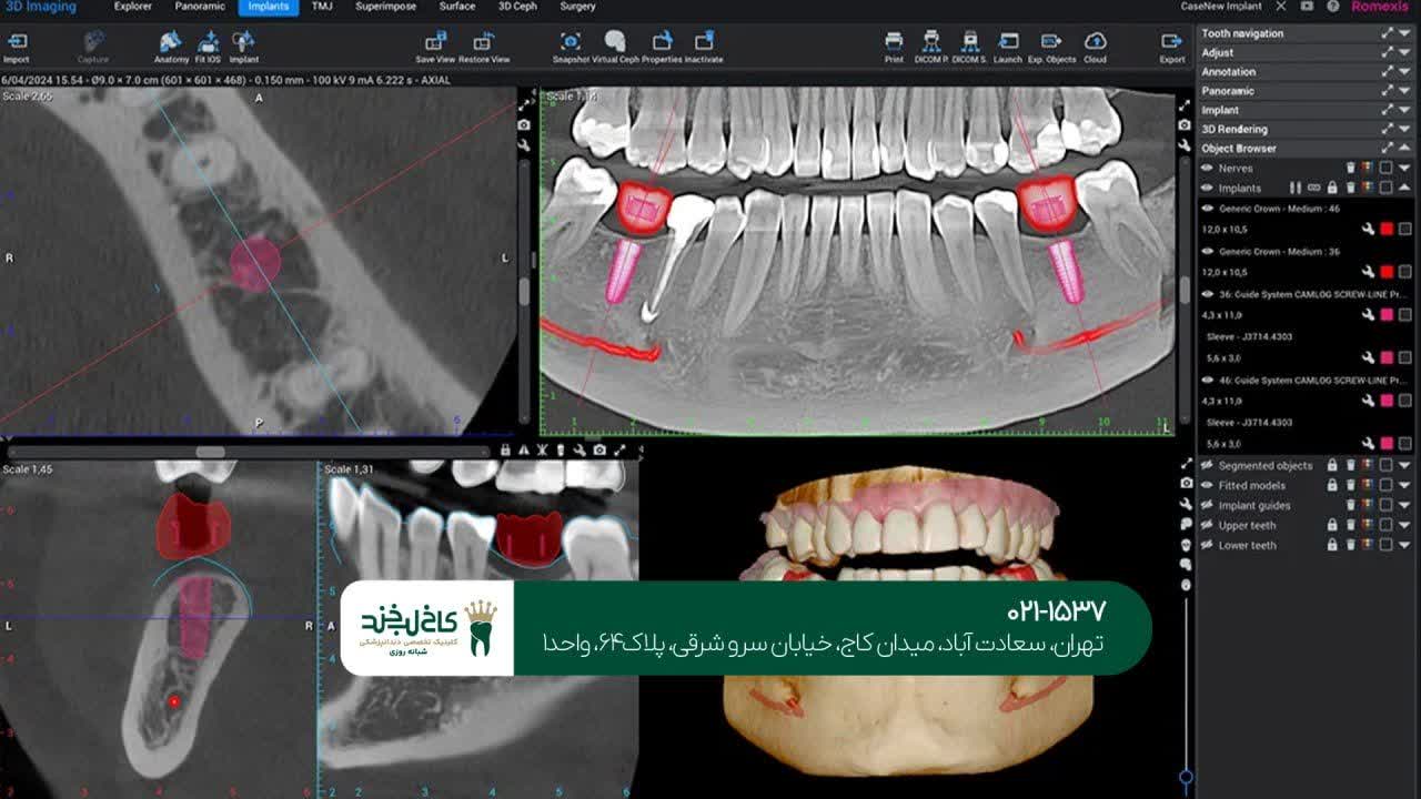 مرکز تخصصی ایمپلنت دیجیتال اقساطی مرکز تخصصی ایمپلنت دیجیتال اقساطی