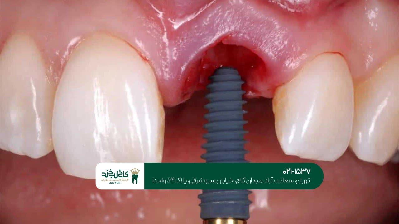 کاشت دندان اقساطی در شمال شهر کاشت دندان اقساطی در شمال شهر