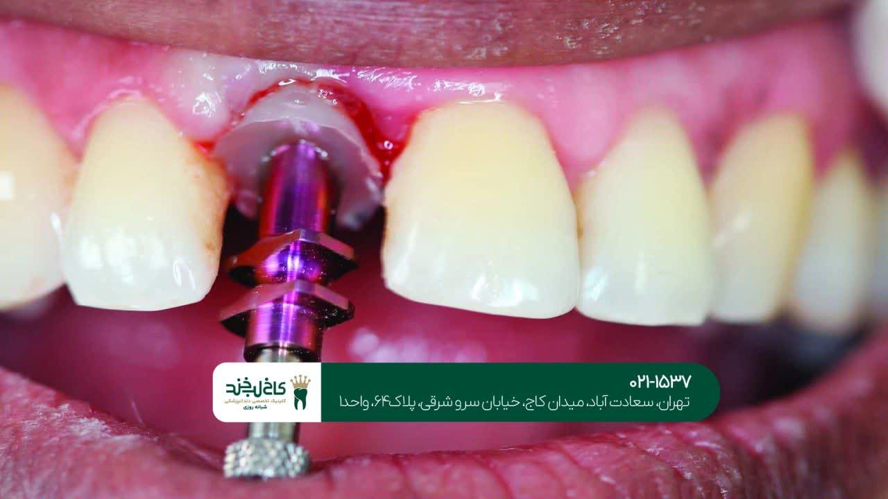 کاشت دندان اقساطی در شمال شهر کاشت دندان اقساطی در شمال شهر