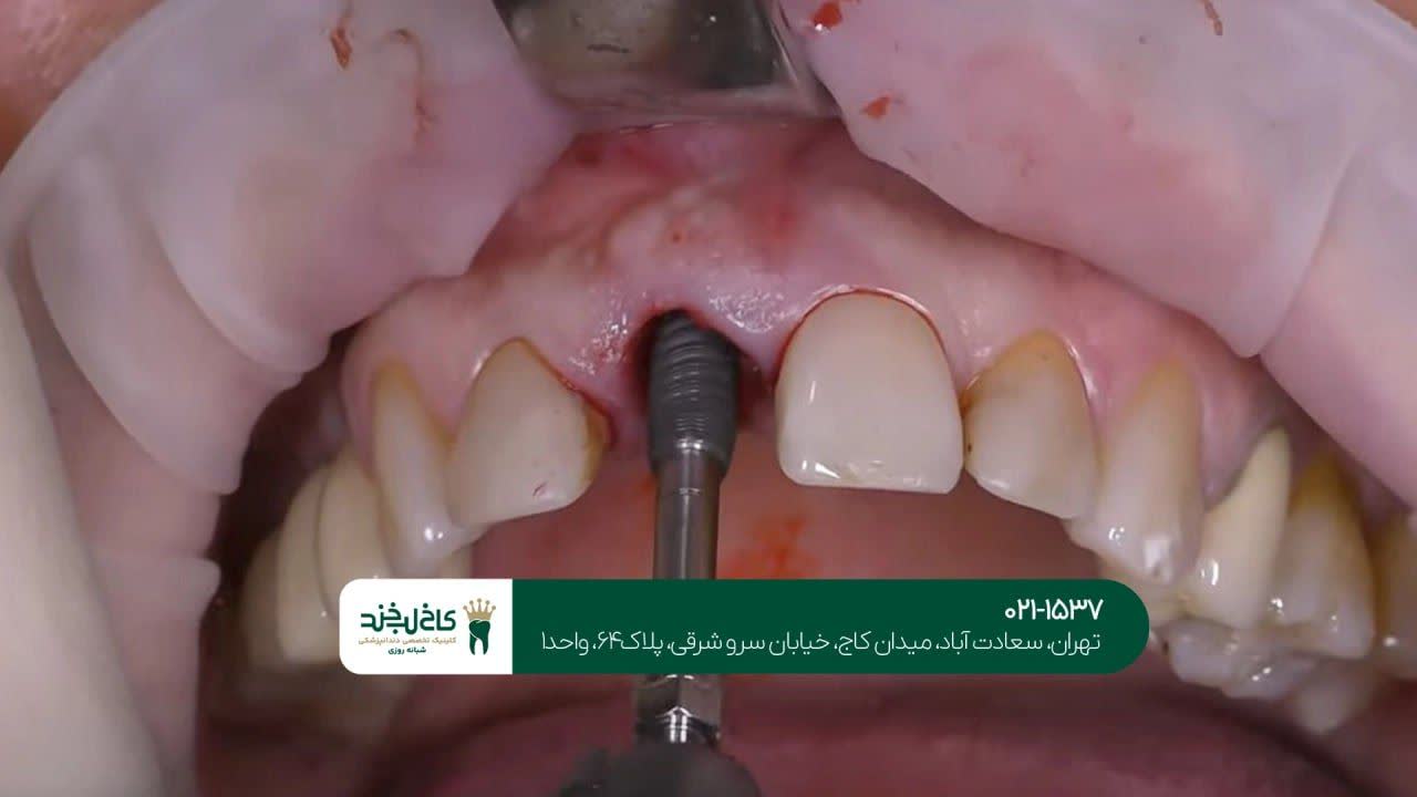 کاشت دندان اقساطی در شمال شهر کاشت دندان اقساطی در شمال شهر