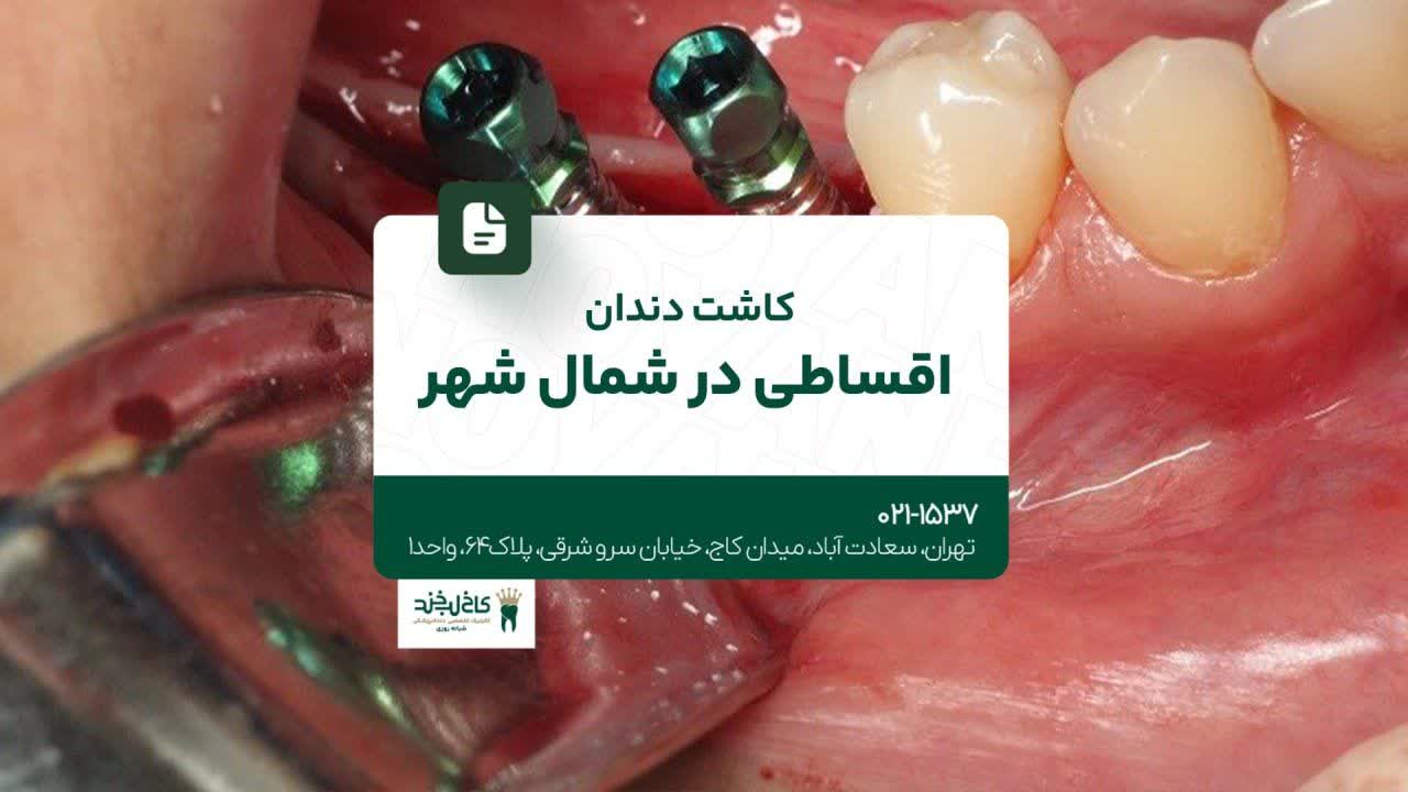 کاشت دندان اقساطی در شمال شهر کاشت دندان اقساطی در شمال شهر