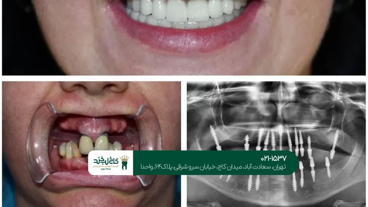 ایمپلنت اقساطی برای فک کامل