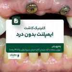 کلینیک کاشت ایمپلنت بدون درد