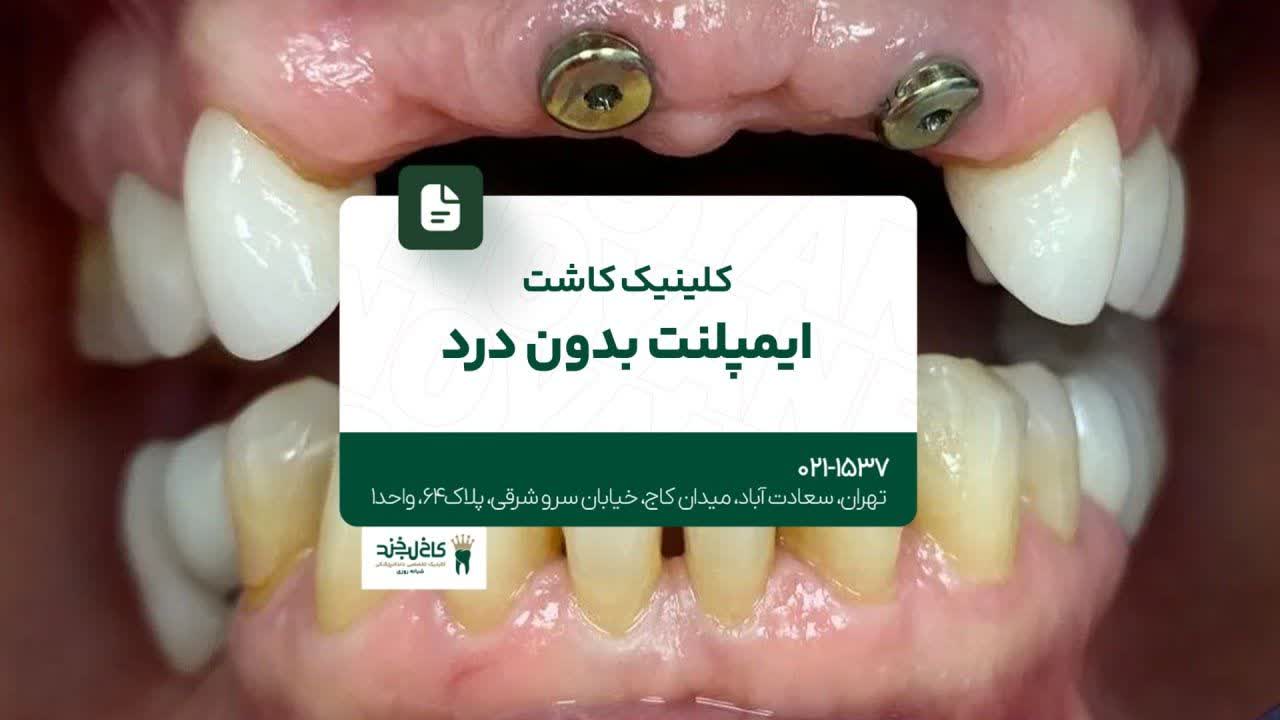 کلینیک کاشت ایمپلنت بدون درد