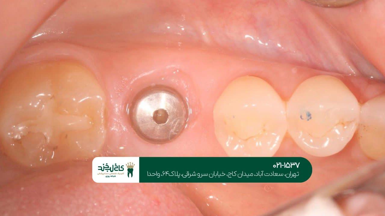 کلینیک کاشت ایمپلنت بدون درد