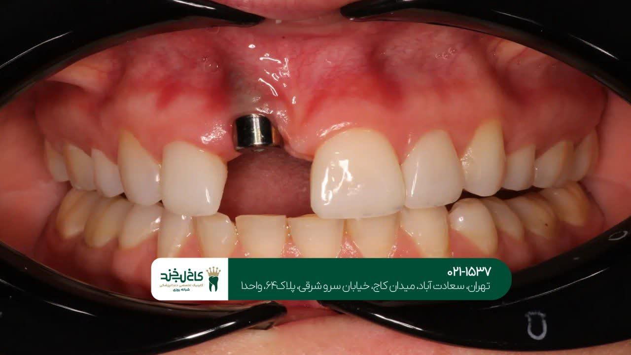 کلینیک کاشت ایمپلنت بدون درد