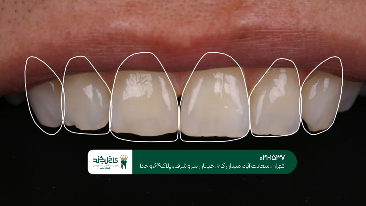 طراحی لبخند دیجیتال اقساطی