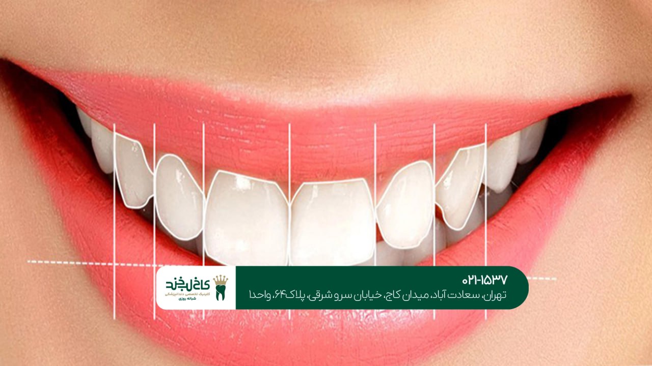 طراحی لبخند دیجیتال اقساطی