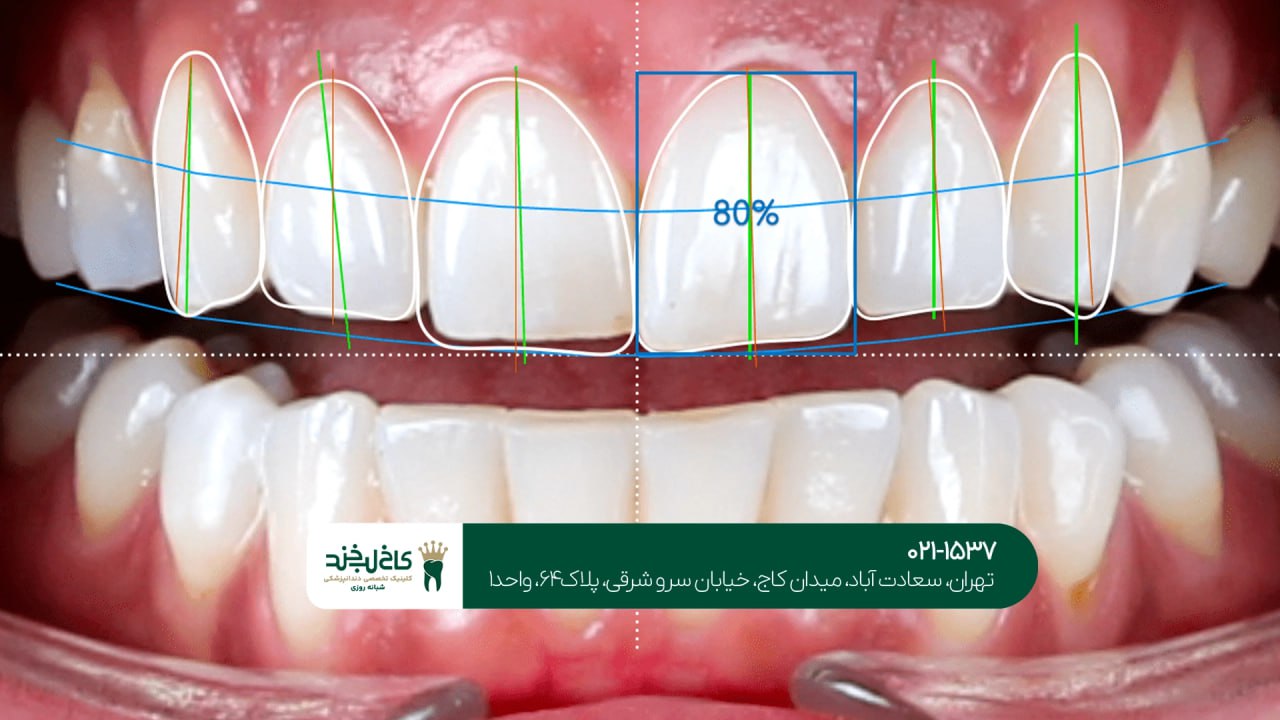 طراحی لبخند دیجیتال اقساطی