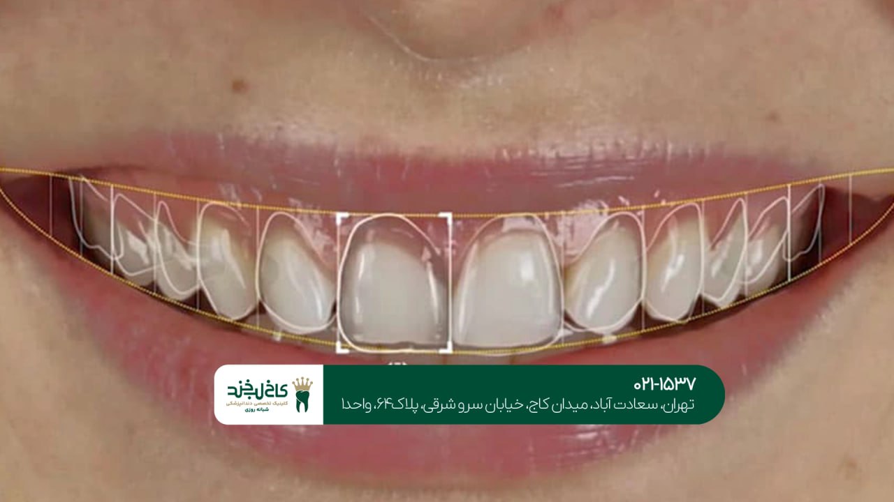 دندانپزشکی حرفه ای برای اصلاح طرح لبخند دندانپزشکی حرفه ای برای اصلاح طرح لبخند