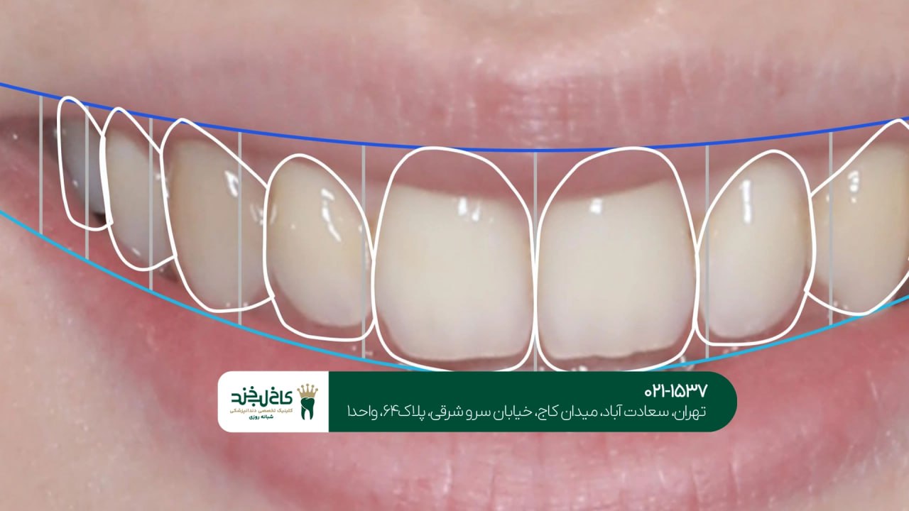 دندانپزشکی حرفه ای برای اصلاح طرح لبخند دندانپزشکی حرفه ای برای اصلاح طرح لبخند