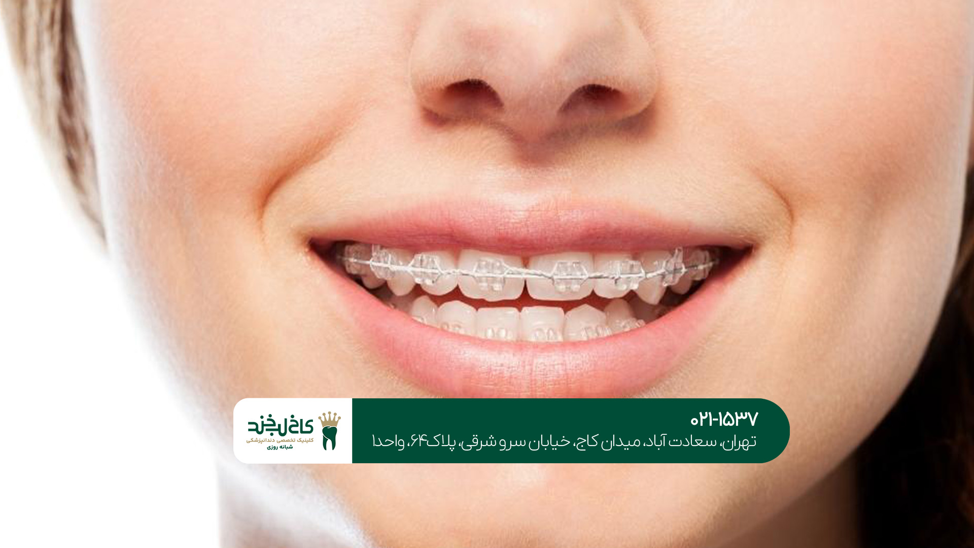 ارتودنسی تخصصی و نامرئی دندان ارتودنسی تخصصی و نامرئی دندان