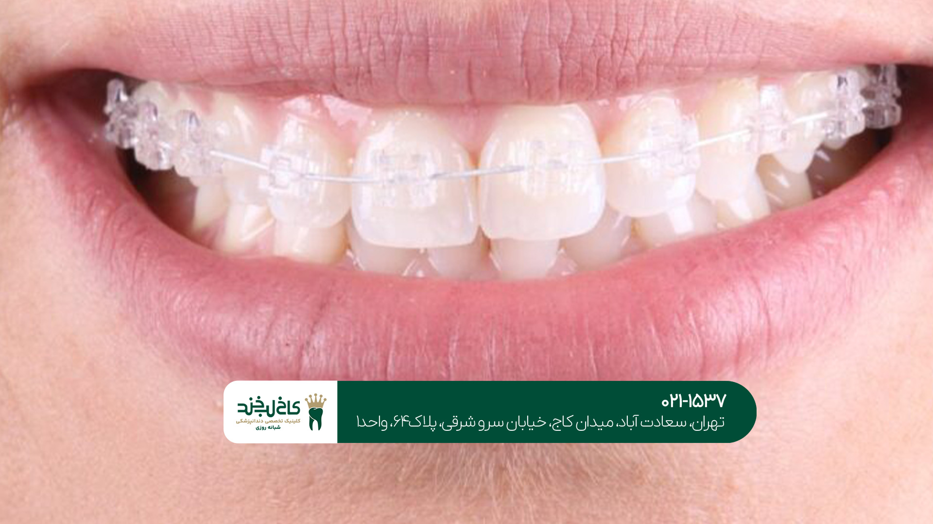 ارتودنسی تخصصی و نامرئی دندان ارتودنسی تخصصی و نامرئی دندان