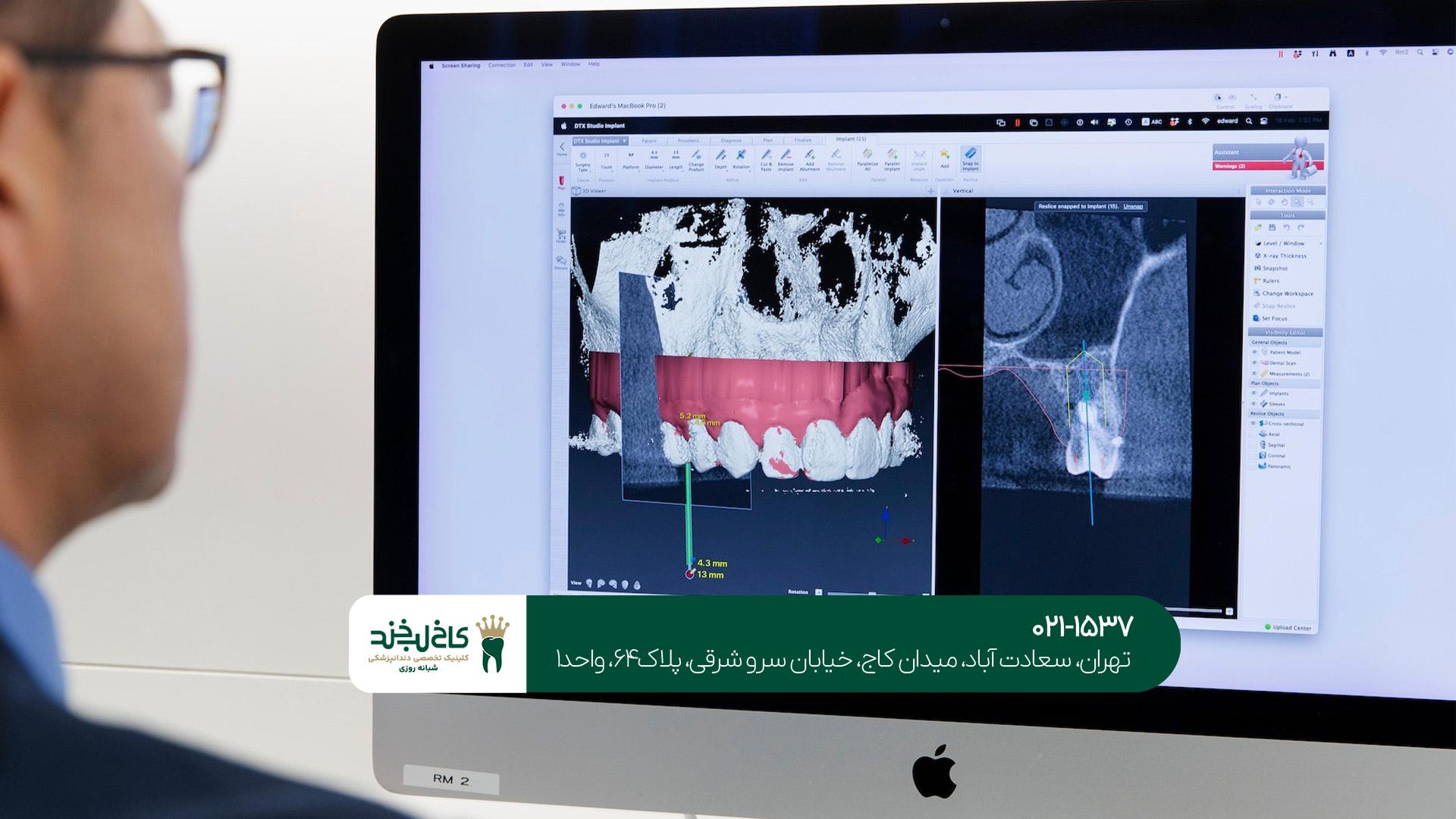 تفاوت ایمپلنت دیجیتال و معمولی تفاوت ایمپلنت دیجیتال و معمولی
