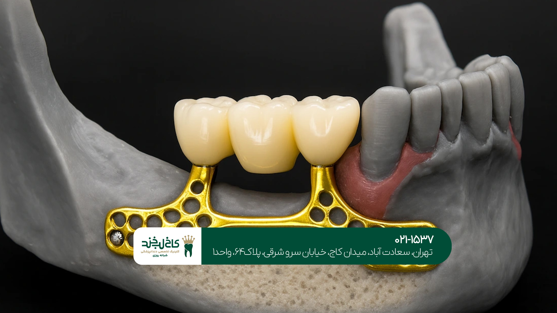 تفاوت ایمپلنت دیجیتال و معمولی تفاوت ایمپلنت دیجیتال و معمولی