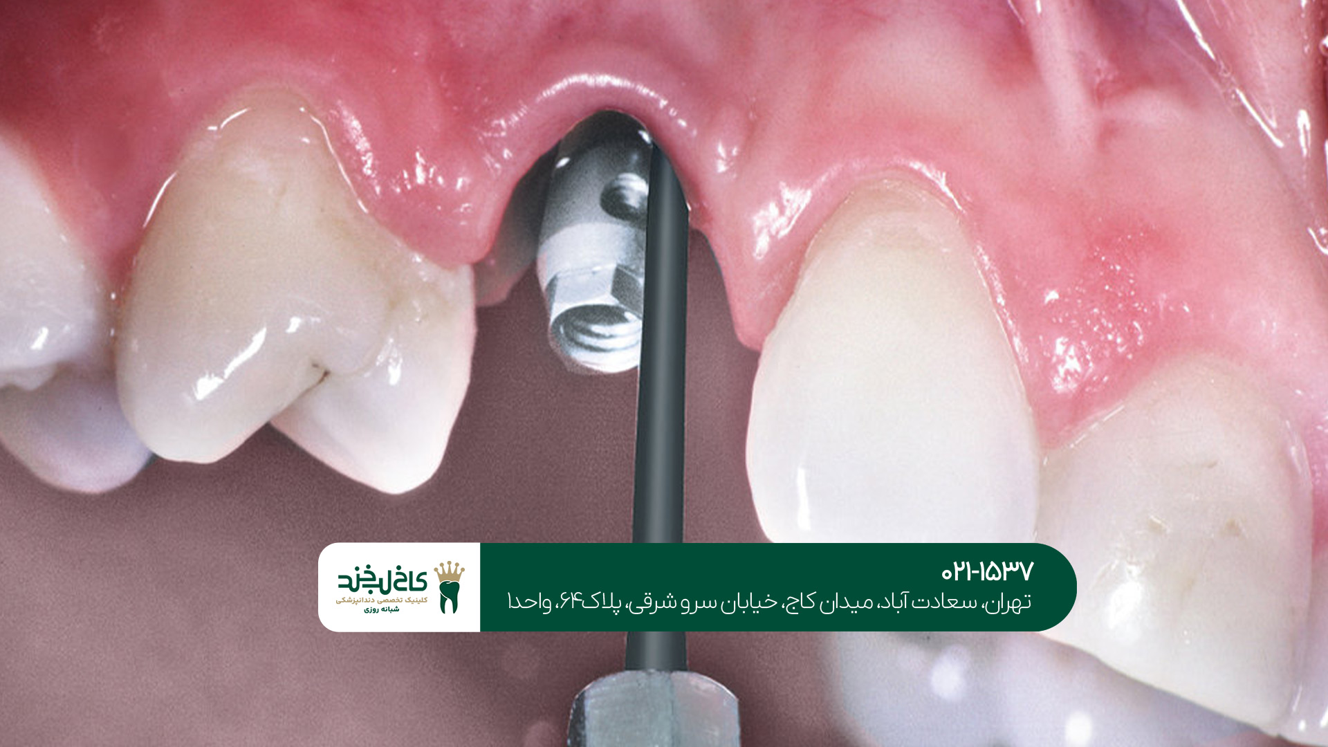 جدیدترین متد کاشت دندان