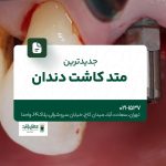 جدیدترین متد کاشت دندان